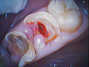 endodoncija-2 (2)